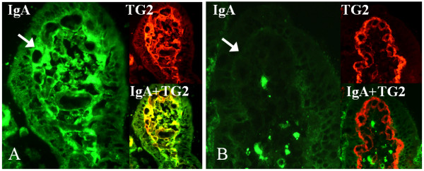 Small-bowel mucosal TG2 (red)-specific IgA deposits (green). A) Positive staining (arrow) in the mucosal villous of a short-term treated coeliac disease patient (gluten-free diet for three years). B) Negative IgA deposits (arrow) in the small-bowel mucosa of a long-term treated coeliac disease patient (gluten-free diet for eight years). Co-localisation of IgA deposits with TG2 is shown in yellow.